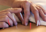 acupuntura-barueri-1514465939